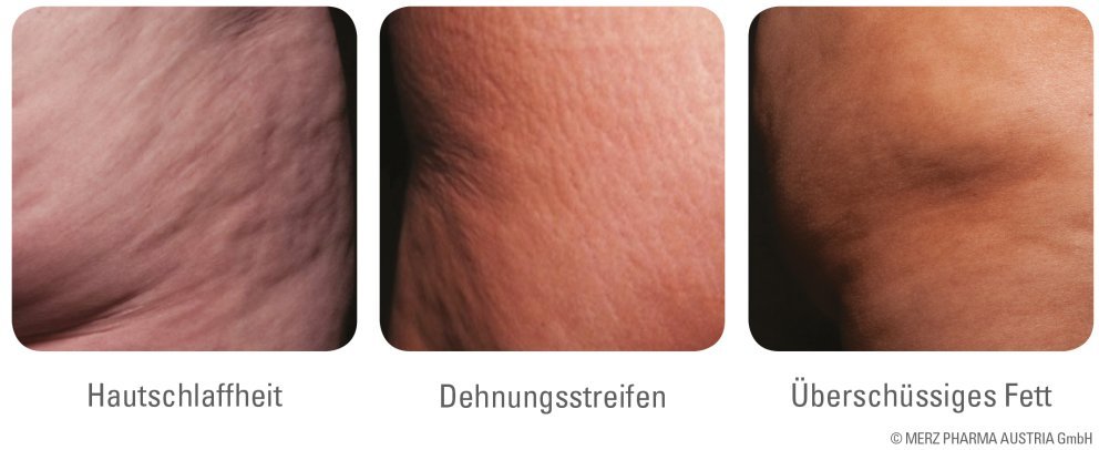 Die Ursachen von Cellulite