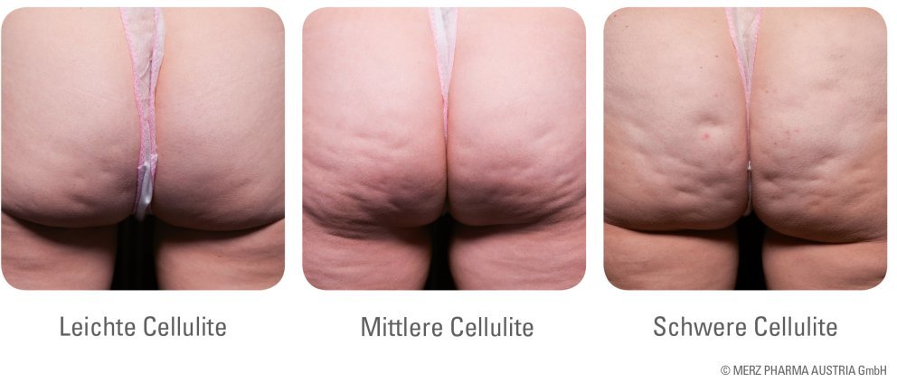 Arten der Cellulite Arten der Cellulite