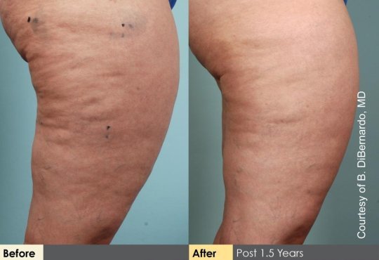 Vor und nach einer Cellulaze Behandlung Vor und nach einer Cellulaze Behandlung