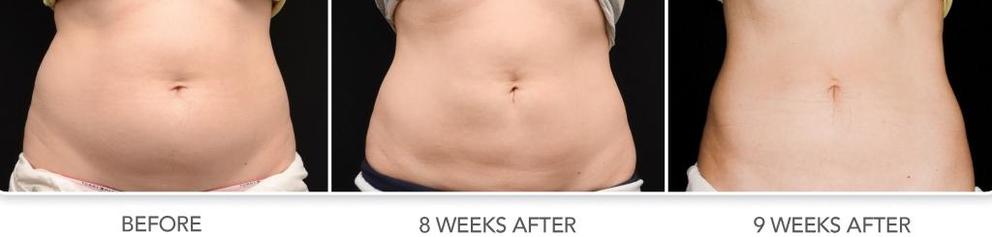 Cool Sculpting Beauty At