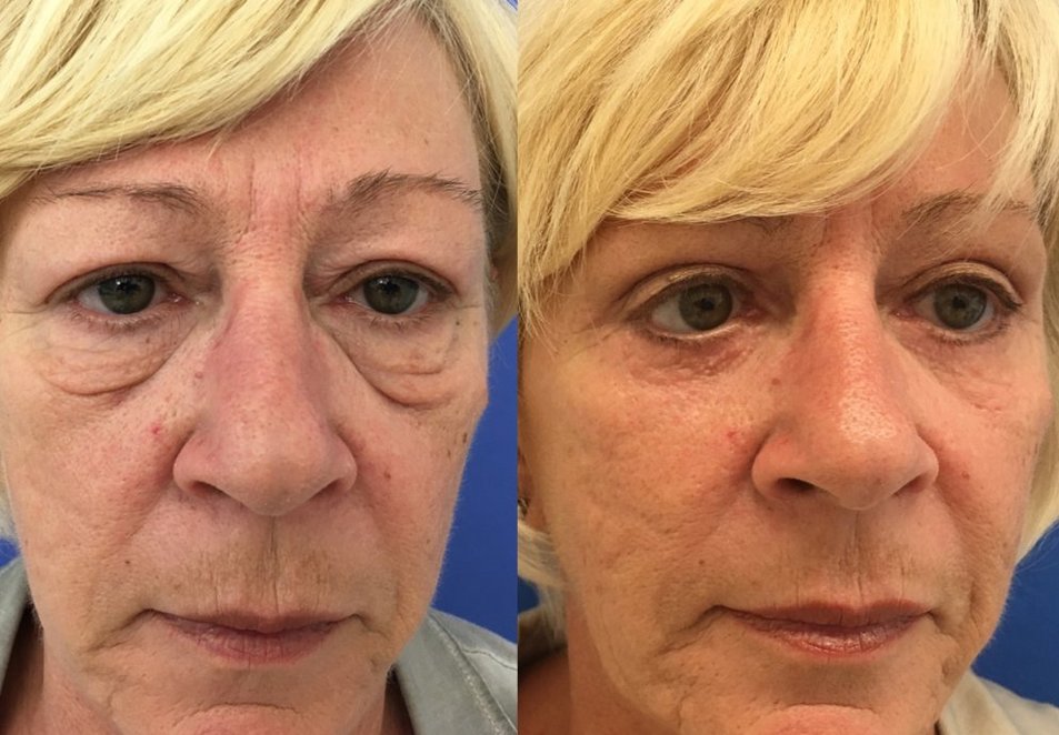 Vor und nach der Lidstraffung Vor und nach der Lidstraffung