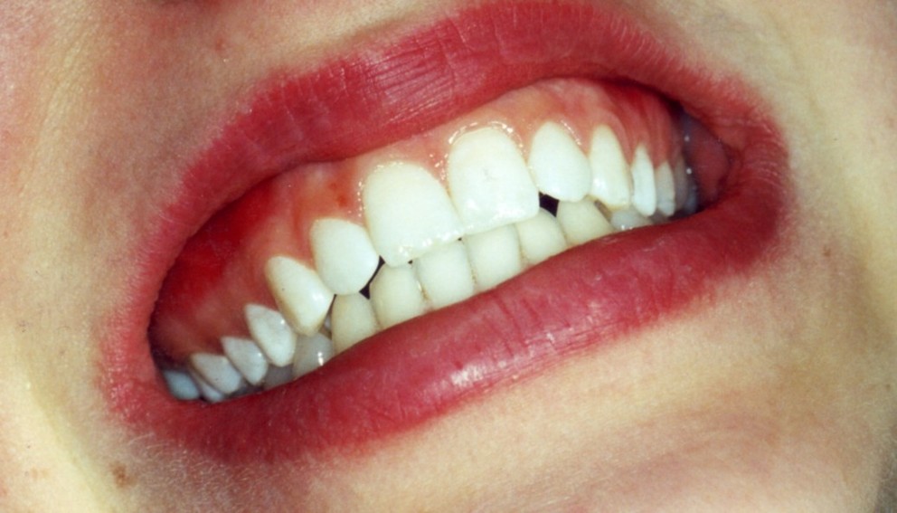 Gebiss mit Veneers Gebiss mit Veneers