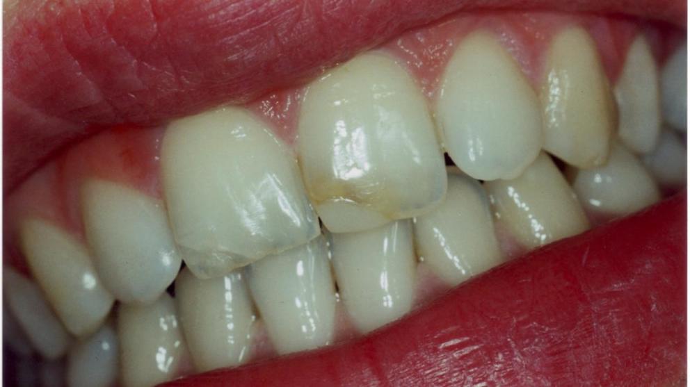 Gebiss ohne Veneers Gebiss ohne Veneers