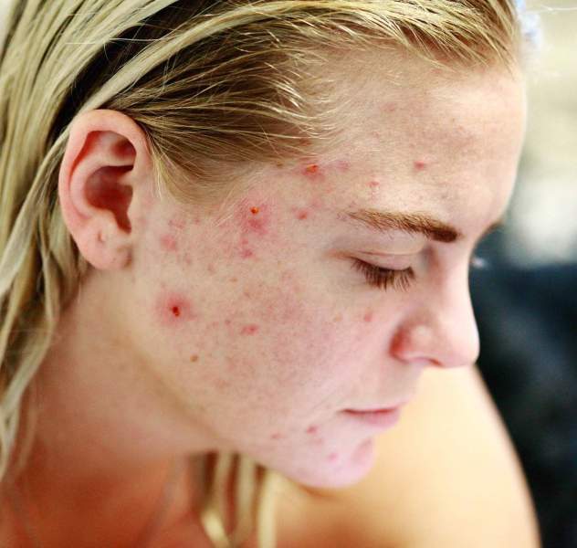Weltweit sind bis zu 95% der Heranwachsenden und 40% der Erwachsenen von Hautunreinheiten wie Akne betroffen. Viele von ihnen leiden an Pickelmalen, die bis zu fünf Jahre oder länger nach Abheilung der akuten Akne sichtbar sein können.