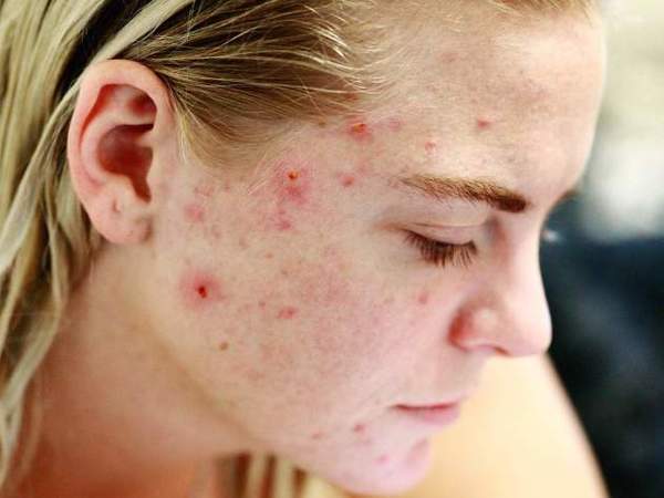Weltweit sind bis zu 95% der Heranwachsenden und 40% der Erwachsenen von Hautunreinheiten wie Akne betroffen. Viele von ihnen leiden an Pickelmalen, die bis zu fünf Jahre oder länger nach Abheilung der akuten Akne sichtbar sein können.