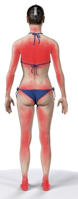 Sonnenbrand Sonnenbrand