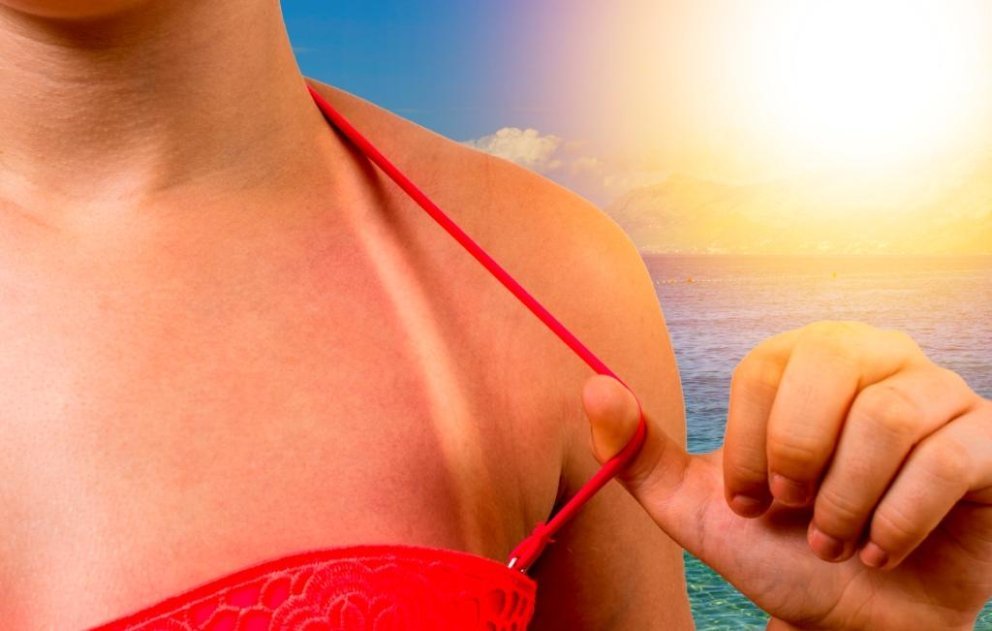 Sonnenbrand Sonnenbrand